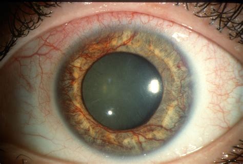 Moran CORE | Neovascularization of the Iris (Rubeosis Iridis)