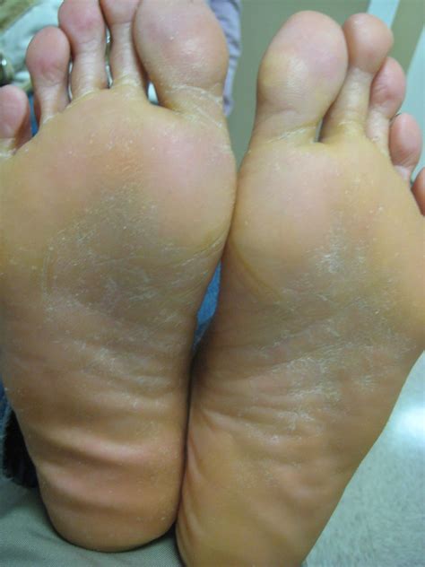 Xerosis Treatment Xerosis (Dry Skin) Dermatology Advisor