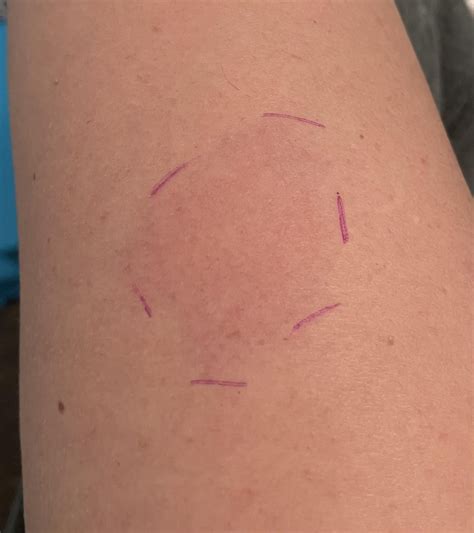 Ajovy injection reaction? : r/migraine