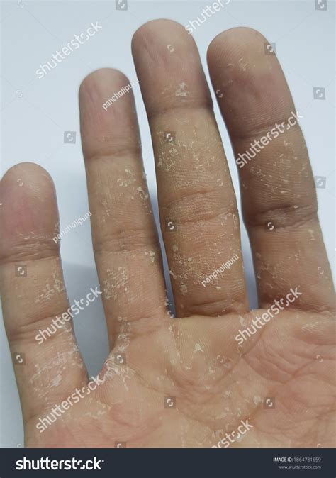 skin peeling  hand keratolysis exfoliativa stock photo