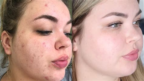 Accutane Before And After