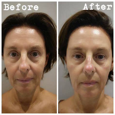 The ins and out of Hyaluronic Acid (HA) and why it’s my favourite ...