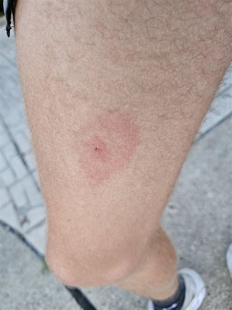 Bug Bite/rash : r/DiagnoseMe