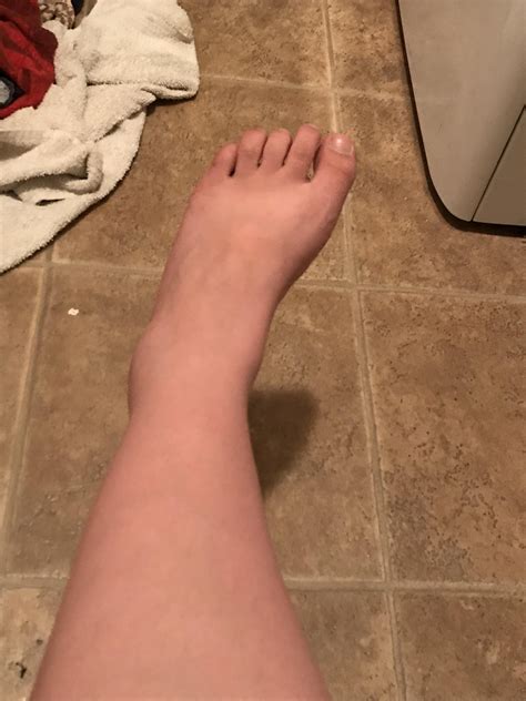 Sprained my ankle. : r/WTF