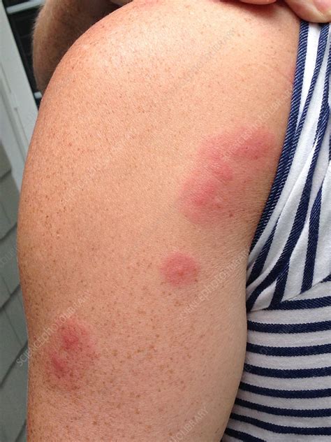 How A Bed Bug Bite Looks Like at Karen Smith blog