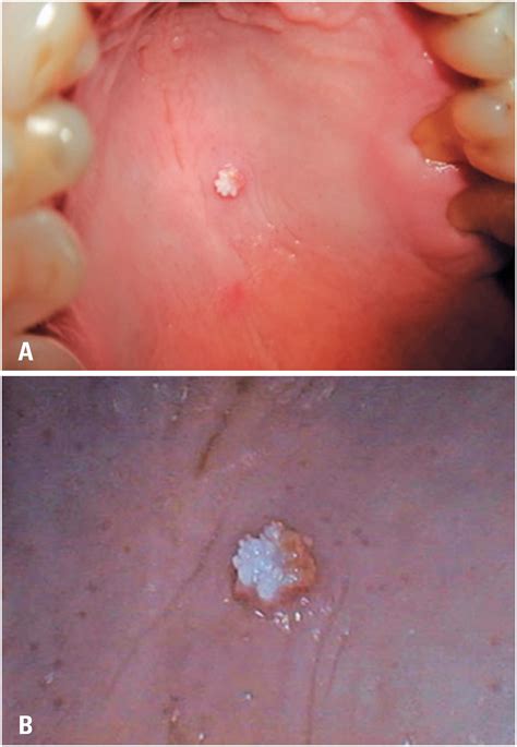 Squamous Papilloma Tongue