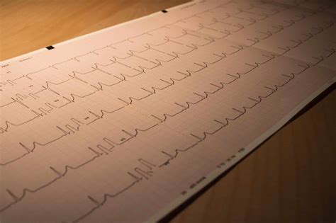 ECG vs EKG - What's the Difference?