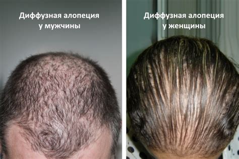 Диффузная алопеция: причины, симптомы, лечение