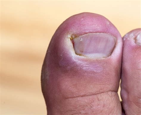 Traiter un ongle incarné - Mon Infirmière Privée CL