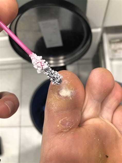 Stupidly stopped treating this a couple months ago and they came back