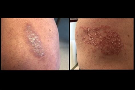 Itchy, Scaly Patches - Clinical Advisor