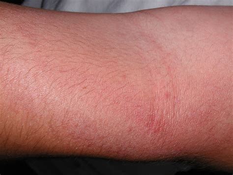 rashes in elbow creases - pictures, photos