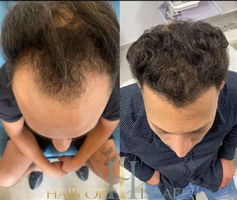 Hair of Israel | השתלות שיער בישראל, השיטה הטורקית המקצוענות הישראלית
