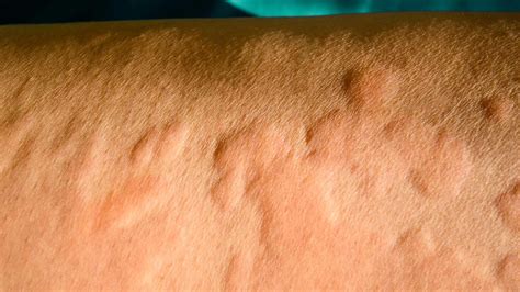 common types  rashes christ memorial