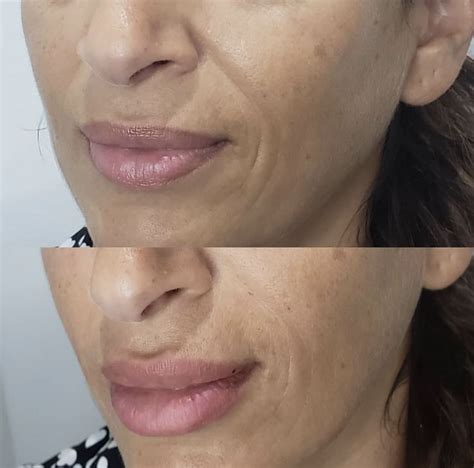 nasolabial fold injections  soften  smile lines  minutes