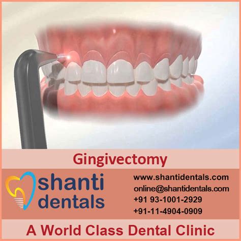 gingivectomy shanti dentals