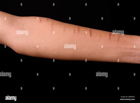 arm  young indian man  cuts  wrist stock photo alamy