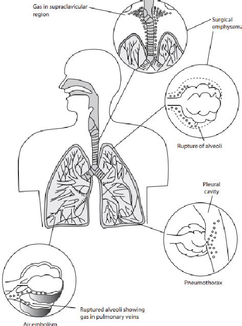 Pulmonary barotrauma during ascending [13] | Download Scientific Diagram