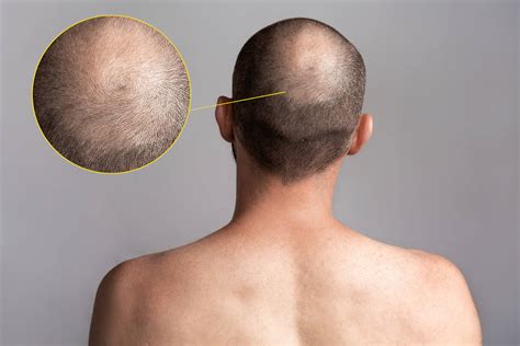 How Does a Crown Hair Transplant Work? | Elithair