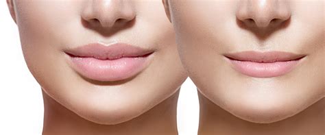 What is Permanent Lip Filler Called?