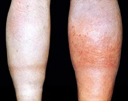 blood clot symptoms   lifeboat news  blog
