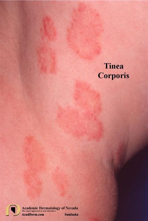 Tinea Barbae