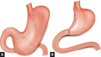 Partial Gastrectomy