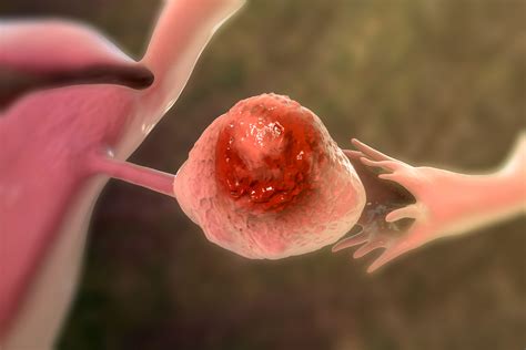 Fertility-Sparing Surgery Outcomes Comparable With Radical Surgery in ...
