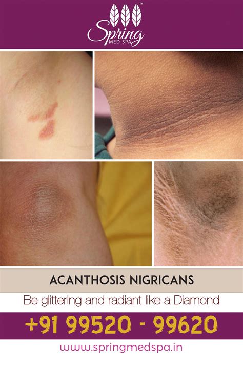 Pin de Muriel en acantosis