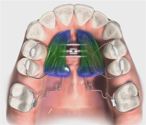 orthodontic appliances altera orthodontics