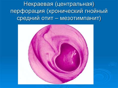 Воспалительные заболевания наружного и среднего уха - презентация онлайн