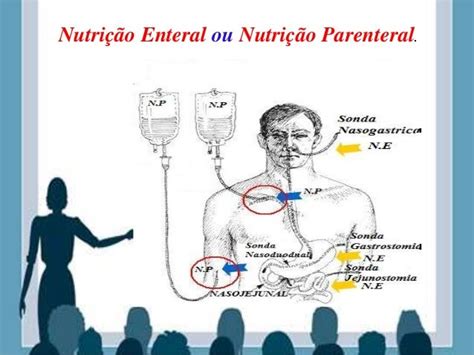 Nutricao Parenteral E Enteral