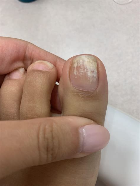 All my other nails are fine but this toenail has this weird whiteness
