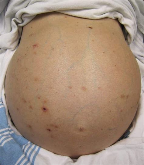 Suy gan: Nguyên nhân, triệu chứng và cách điều trị - YouMed