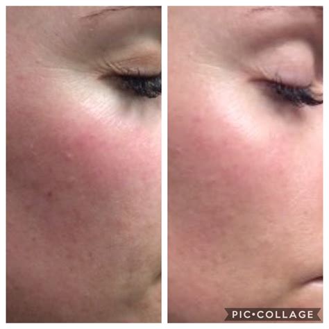 Skin Tightening with Skins Clinique — By Angela