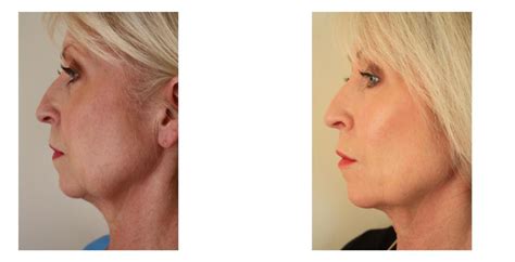 permanent thread lift  youthful skin  essex