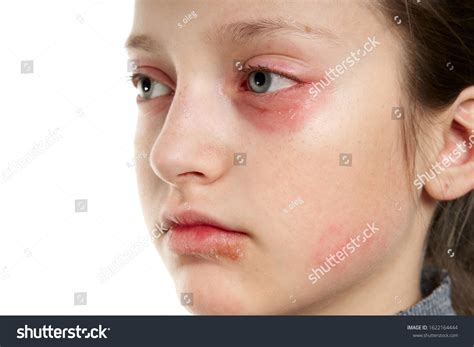allergic reaction skin rash close view stock photo