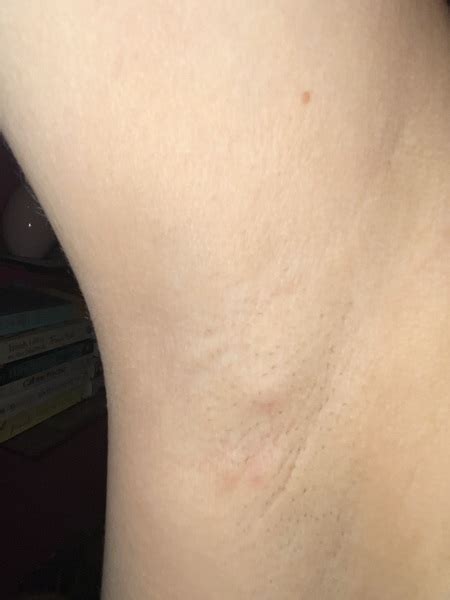 Lump In Armpit