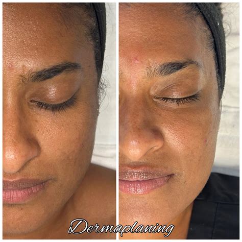 Dermaplaning Valor