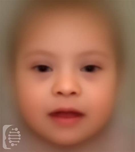 FDNA™ Down syndrome: Key Symptoms, Causes, and Diagnosis