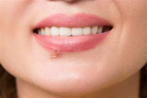 What To Do When Herpes Blisters Burst - Printable Templates: Your Go-To ...