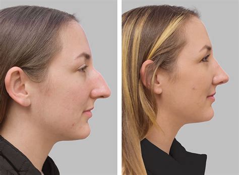 Septoplasty Only Before And After