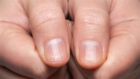 Unhas Estriadas O Que Pode Ser - Unhas estriadas: o que pode ser e como tratá-las | CNN Brasil