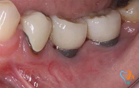 Risk of dental implant infection