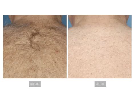 expect ipl hair removal    results konmison