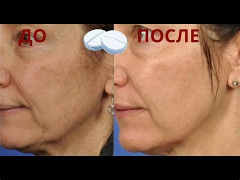 Дешевое аптечное средство для омоложения кожи лица. Аспирин от морщин и ...