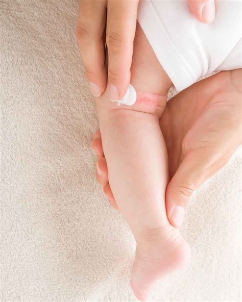 cara mengatasi ruam popok secara alami 3