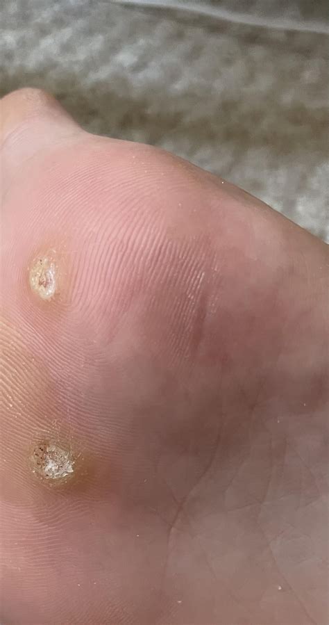 Have these verrucas died? : r/Warts