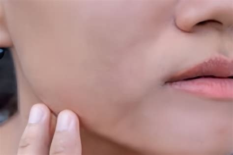 Acne Pro Cure - 20BEAUTY