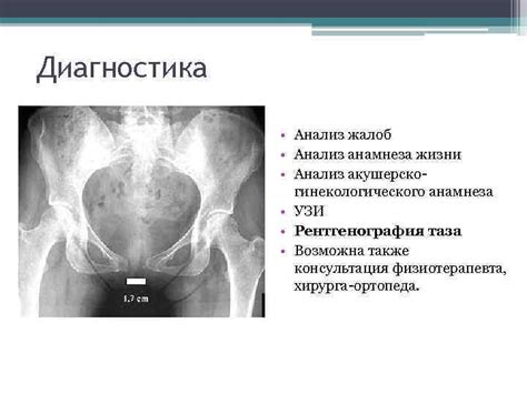 Расхождение лобковой кости при беременности: симптомы, лечение ...
